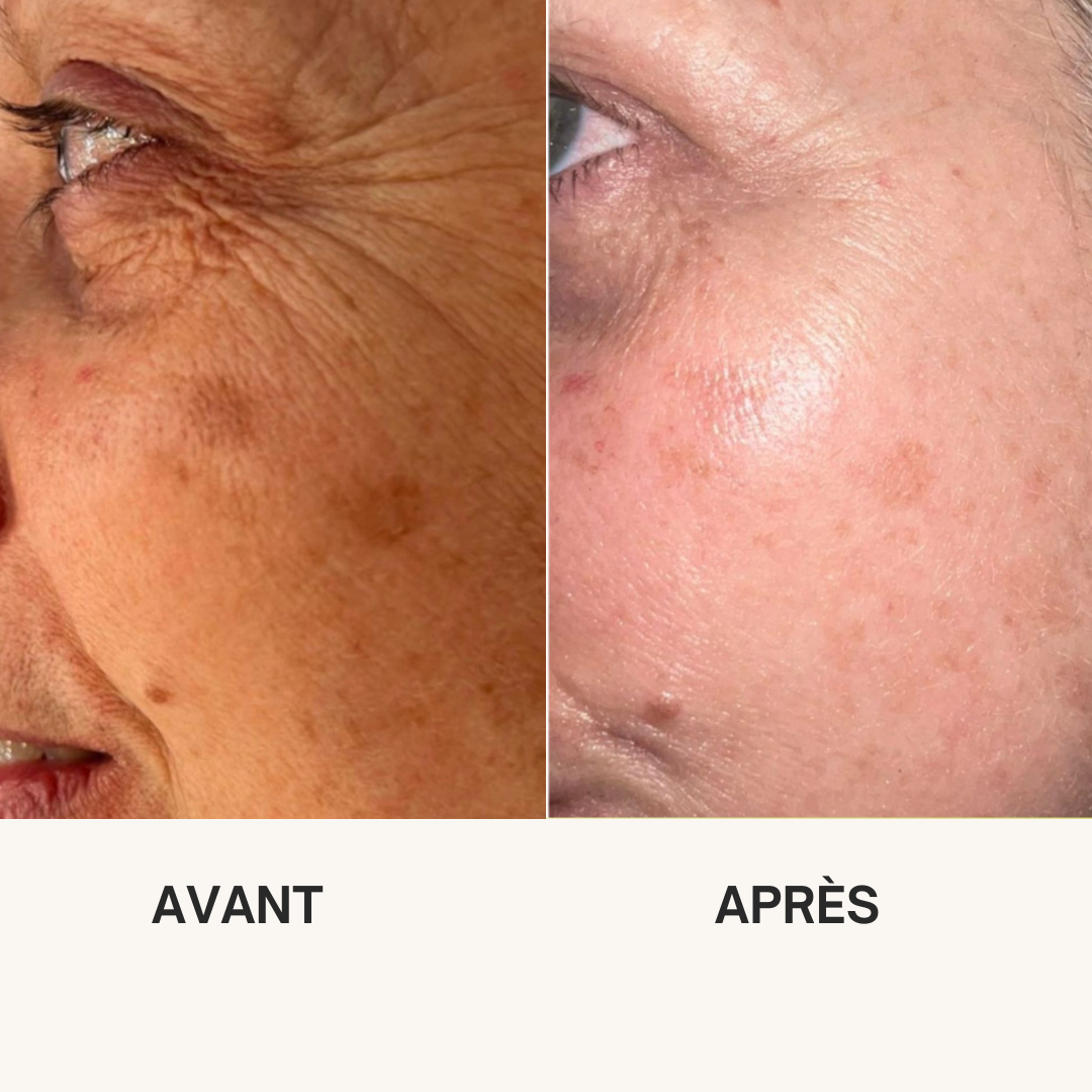 Routine Retilift Lift+ — résultat avant / après