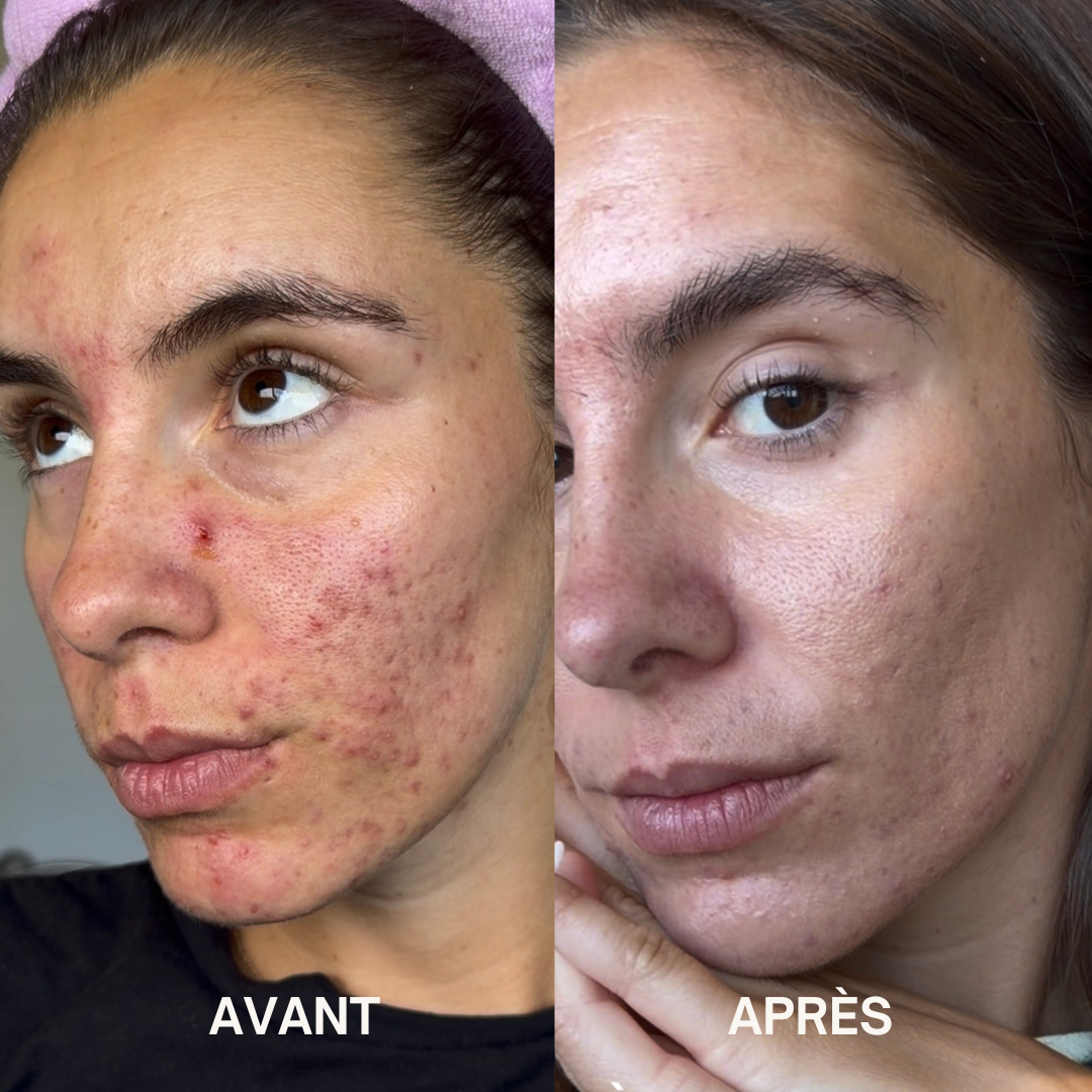 Routine Sébocylique Clear 5 — résultat avant / après