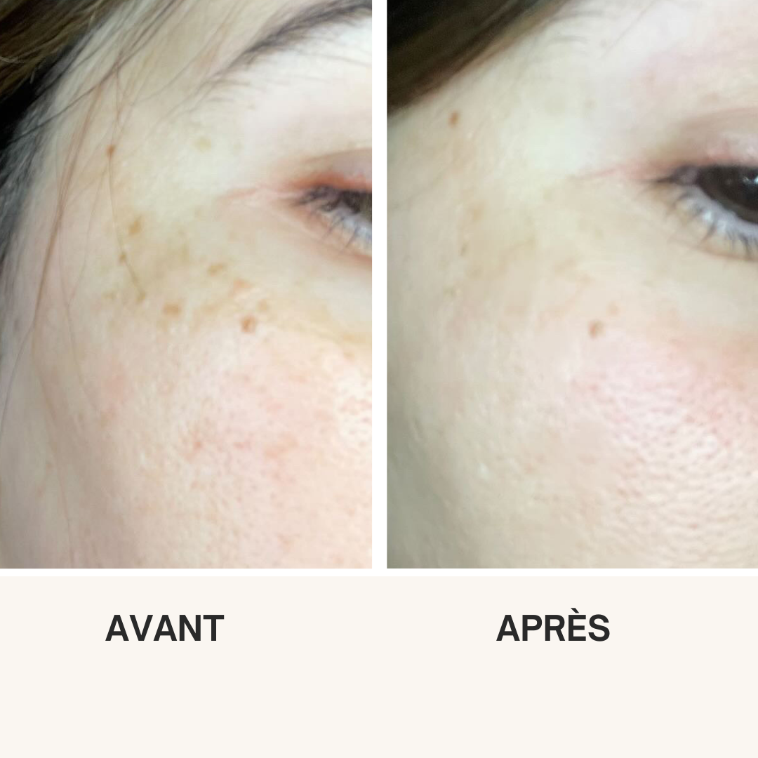 Routine Vitalight Clair+ — résultat avant / après